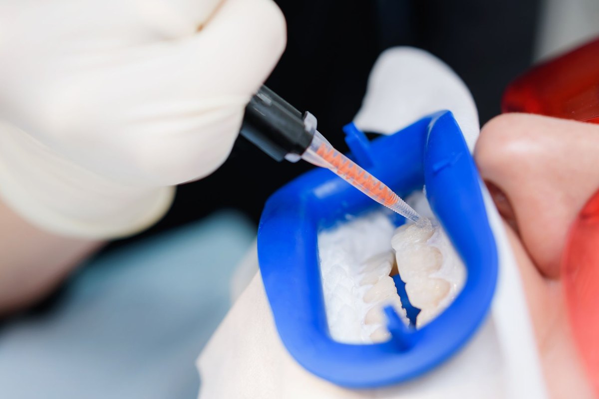 Otturazione dentale eseguita con diga di gomma e materiale composito