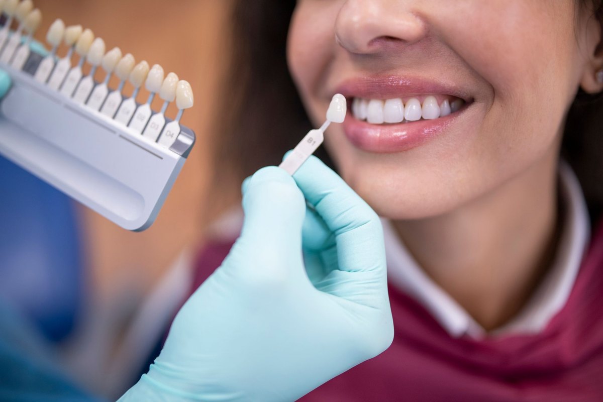 Scelta della tonalità del dente sulla scala colori per lo sbiancamento